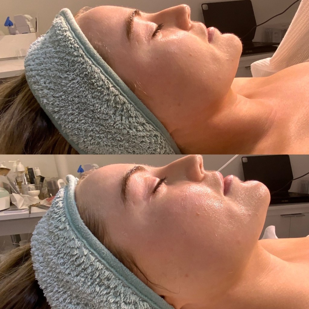 Bionik facial before and after