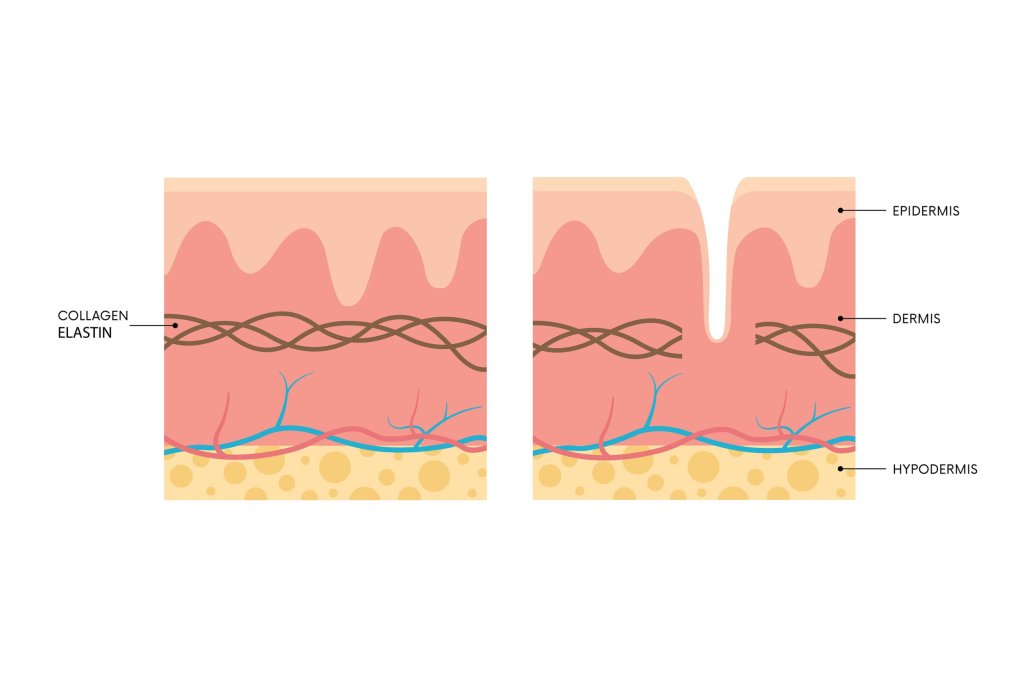 Image: Shutterstock - Anatomy of skin with and without stretch marks